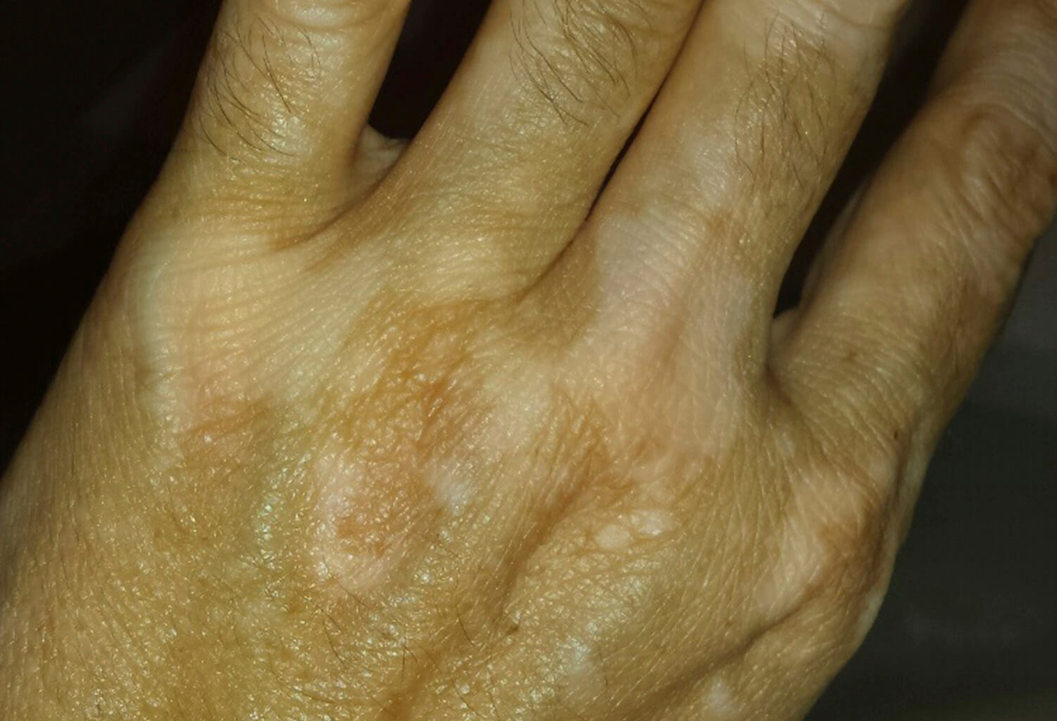 Vitiligo
